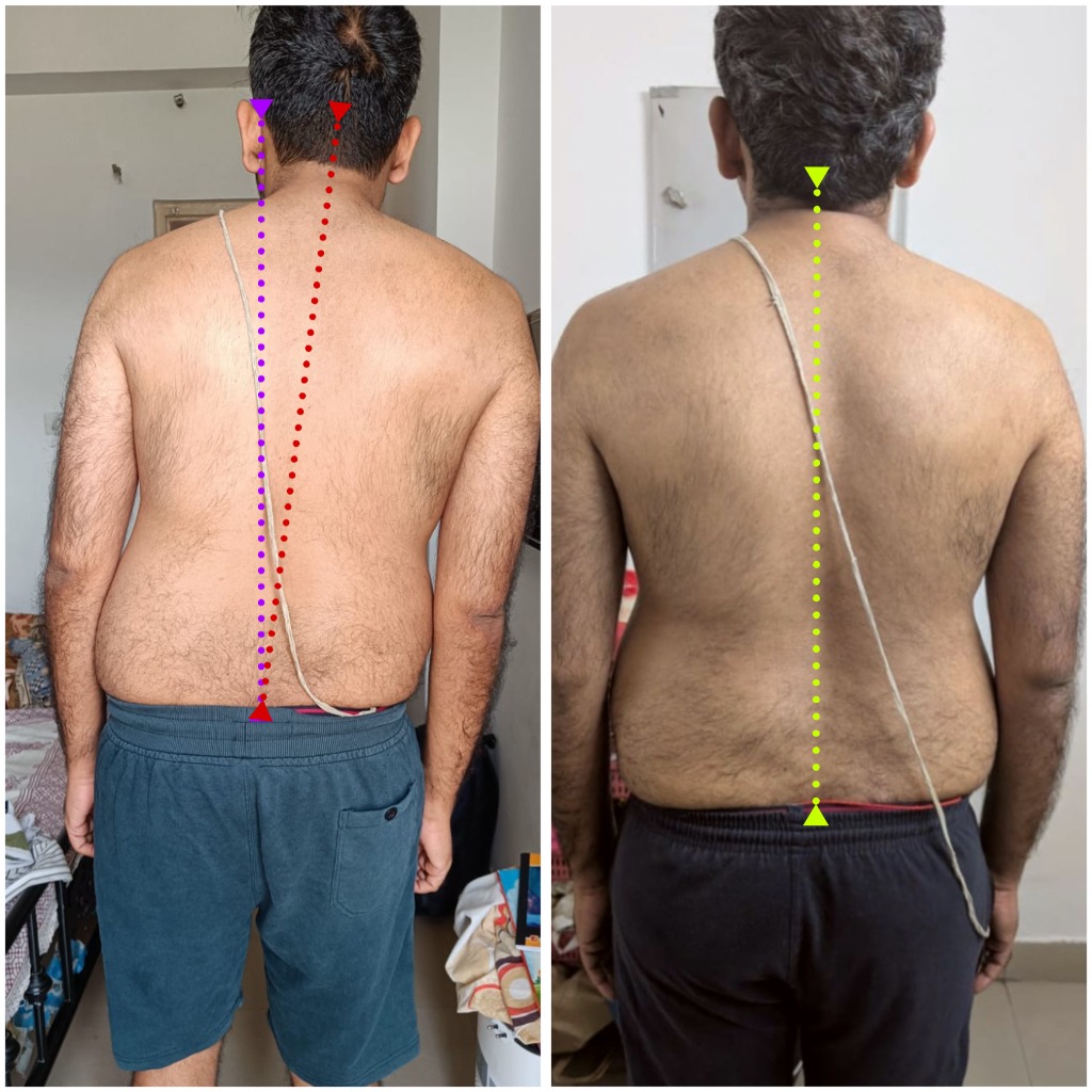 Before and after posture alignment analysis showing visible spinal straightness improvement
